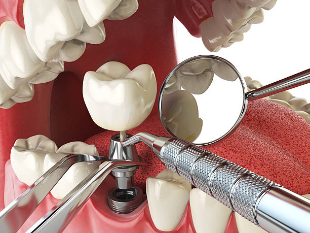 Best Emergency Dentist for Lost Fillings or Crowns in Canton, SD